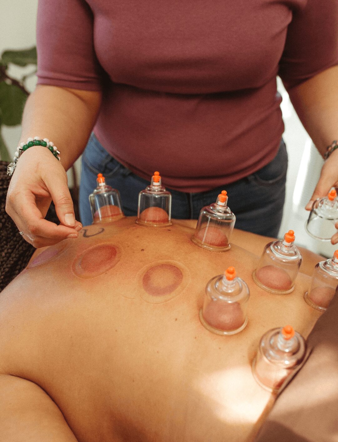 Person receiving cupping therapy on their back with multiple cups placed on skin.
