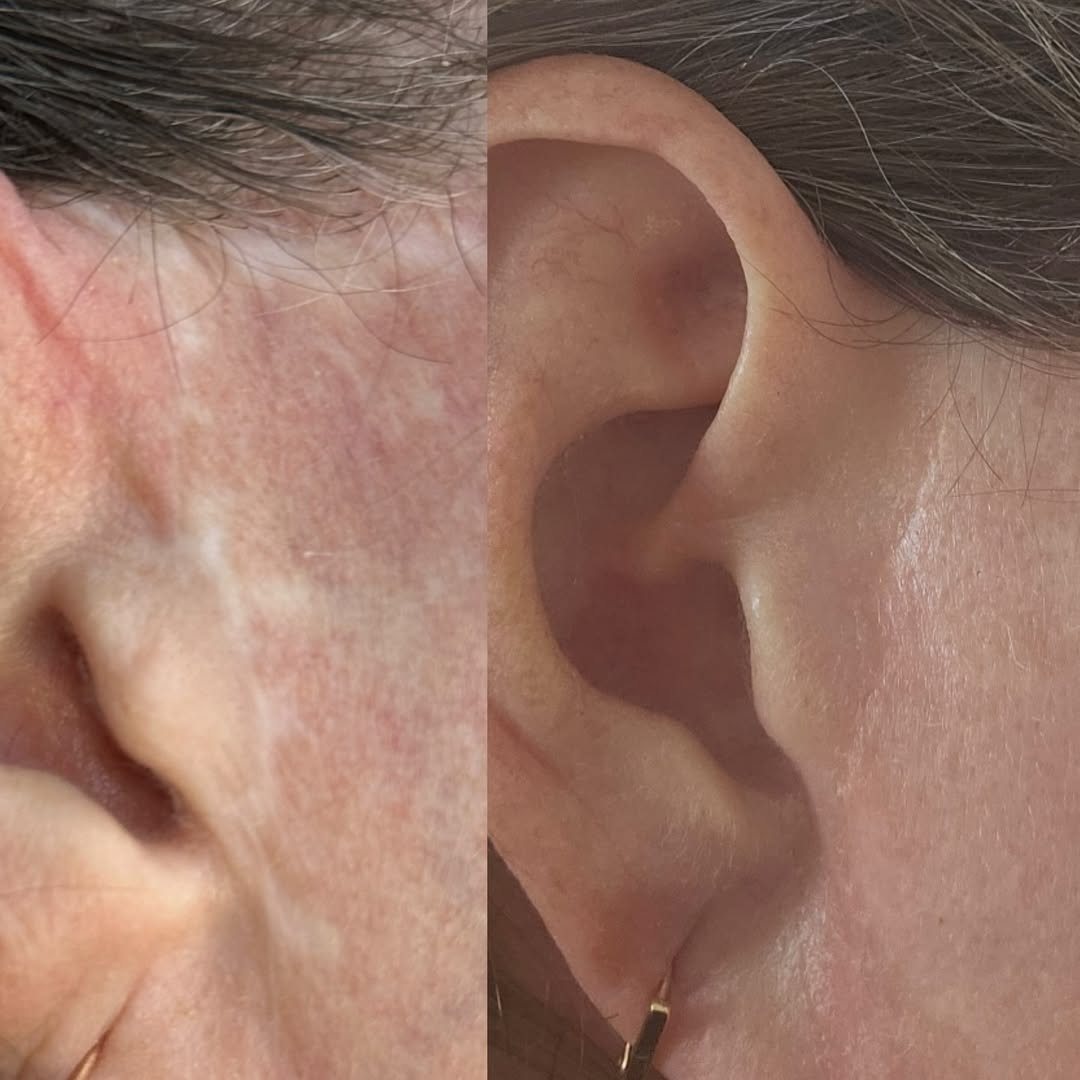 Close-up of a person's face showing before and after skin treatment, focusing on cheek and ear area, side view.