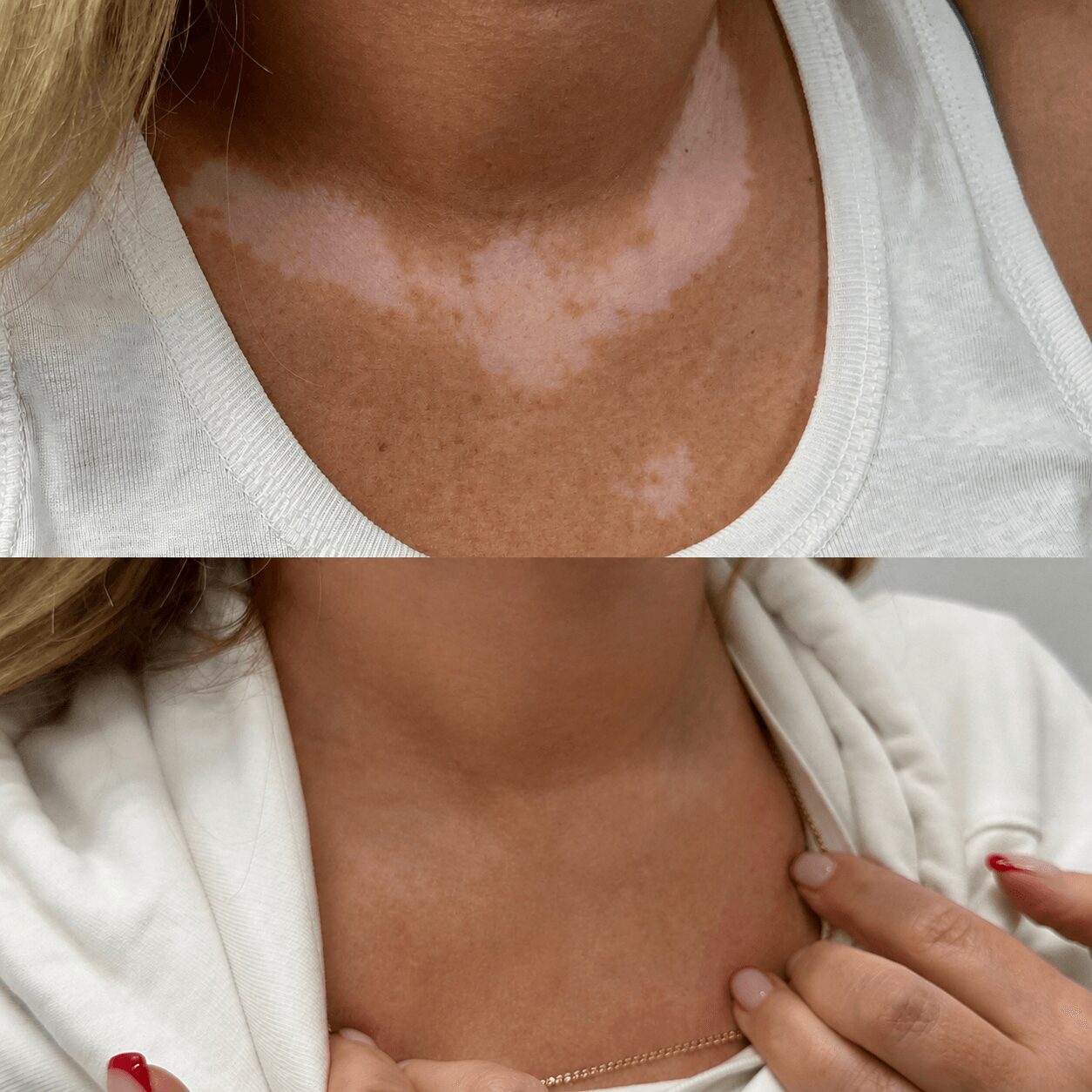 Close-up of a person's neck showing a skin condition with lighter patches, wearing a white top, with another image of the same neck with no visible patches, person holding a white garment.