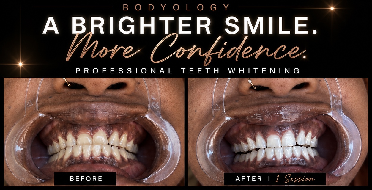 Side-by-side images showing a person's teeth before and after teeth whitening treatment.